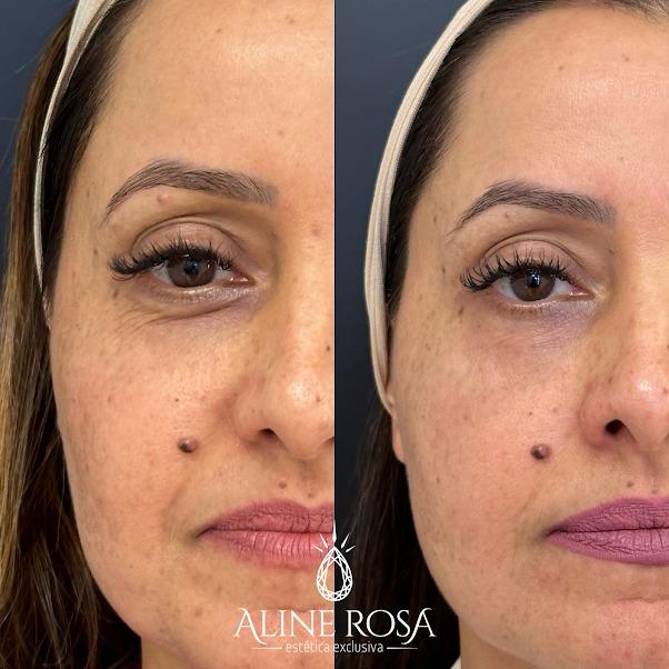 Gerenciamento de Melasma